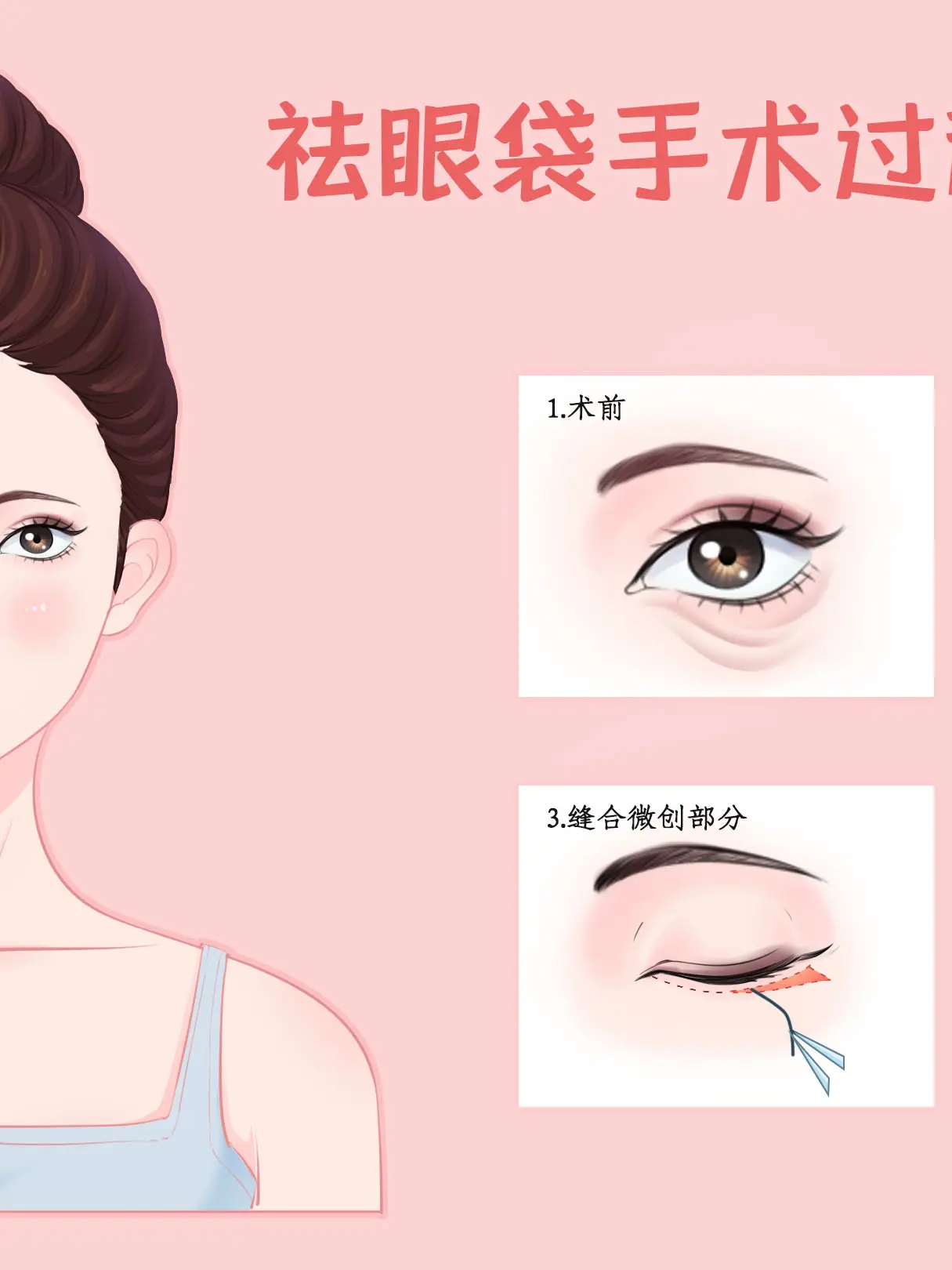 祛眼袋手術過程漫畫封面图片