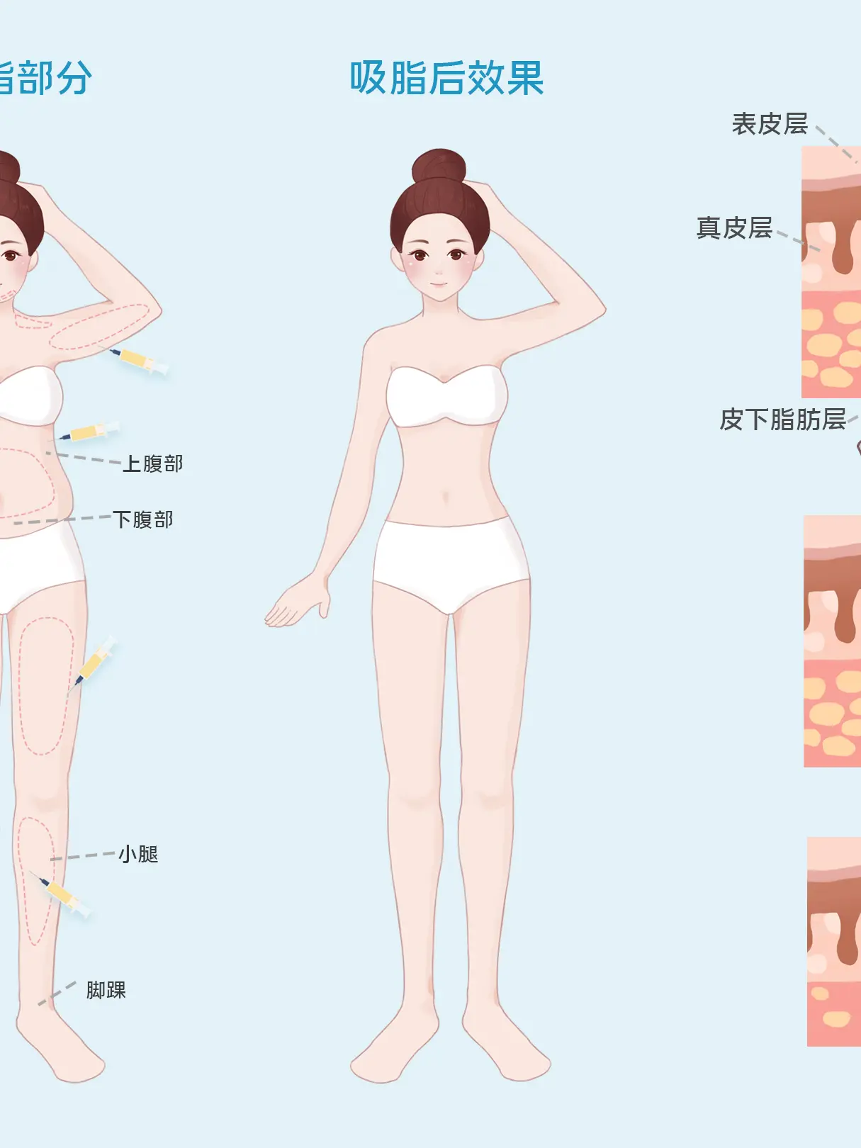 吸脂減肥科普小課堂漫畫封面图片