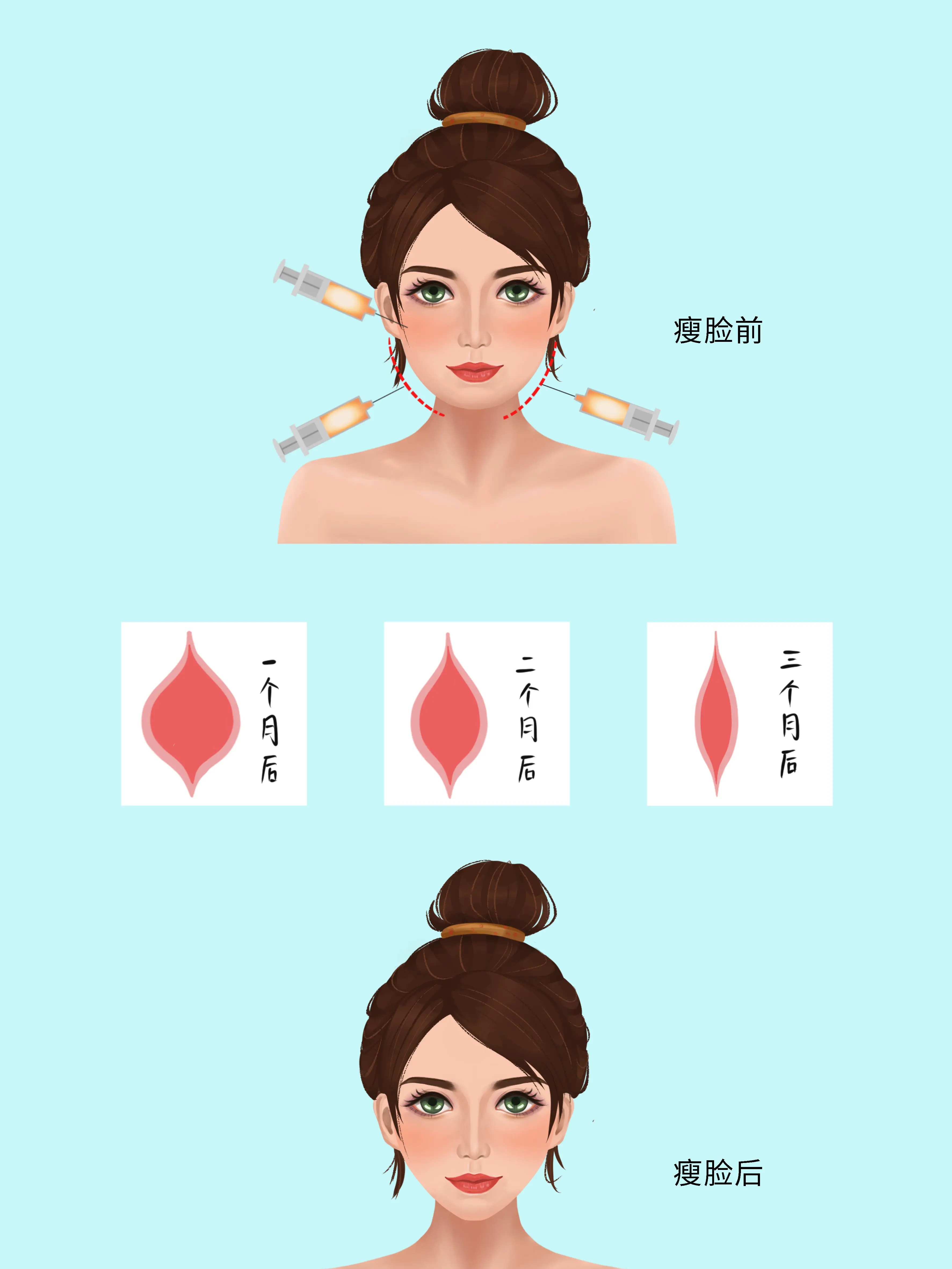瘦臉針科普小課堂漫畫封面图片