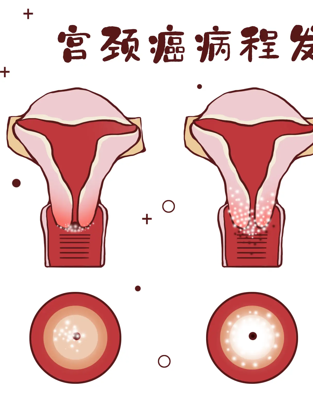 宮頸癌知識小科普漫畫封面图片