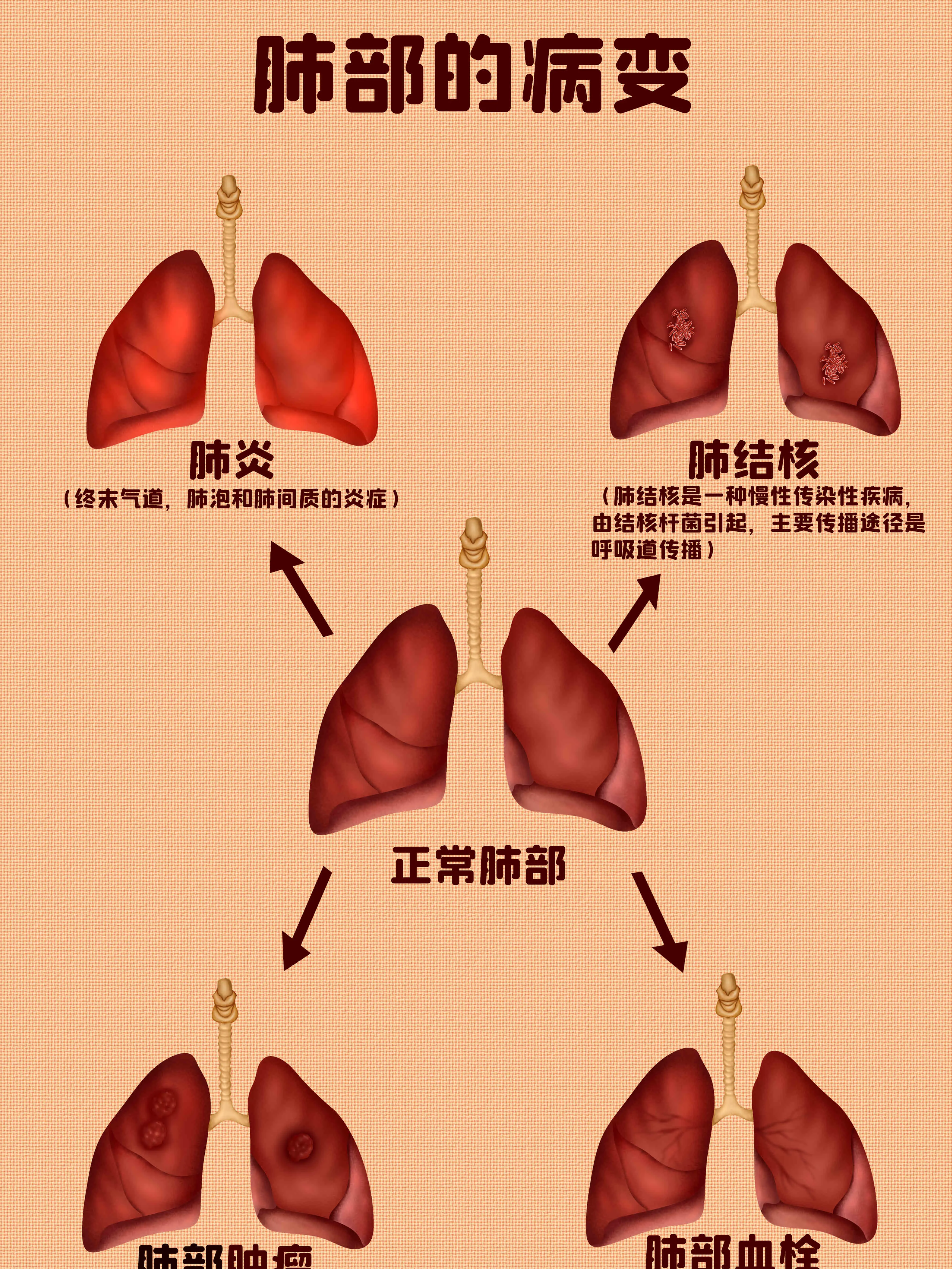 肺部病變知識小科普漫畫封面图片