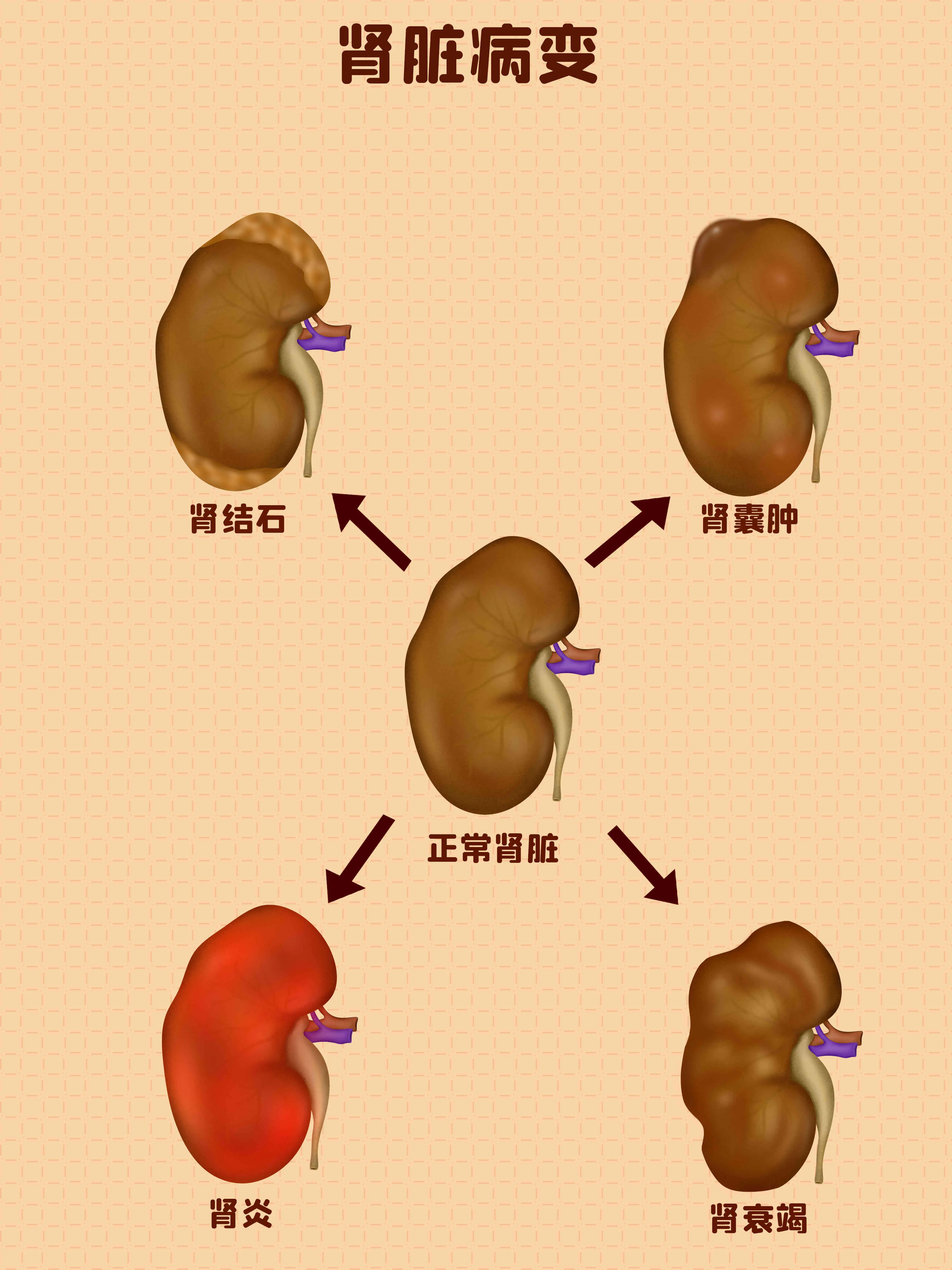 腎髒病變過程知識小科普漫畫封面图片